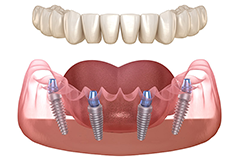 orthosquare dental implant